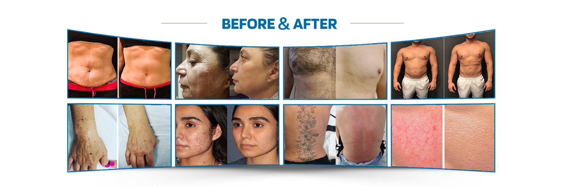 quality Laser Hair Removal Machine factory