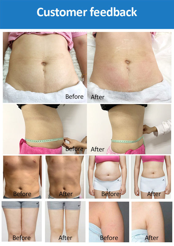 c-slim laser lipo Liposuction Southern Maryland | Waldorf Learn About the Benefits of